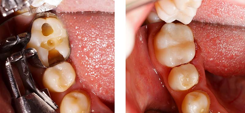 composite-filling-before-after