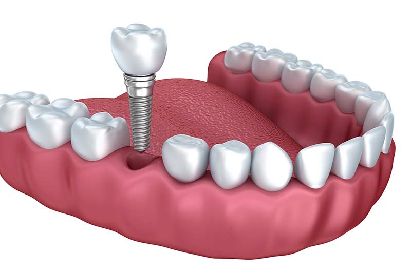 dental-implant-singletooth-lower-jaw