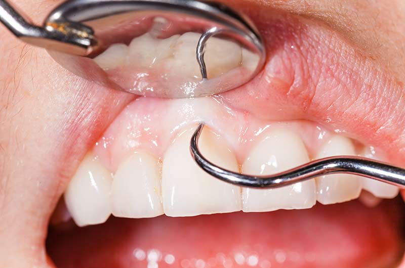 dental-patient-examininggums