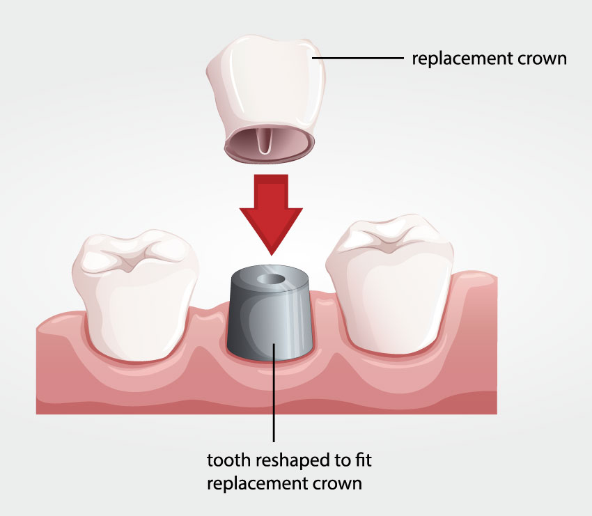 dentalcrownprocedure