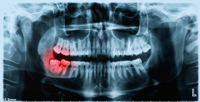 wisdom-teeth-removal-xray